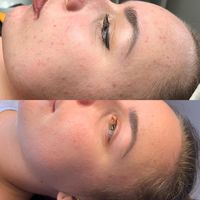 Microneedling