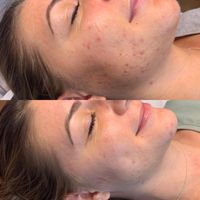 Microneedling2jpeg